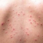 Tratamentos caseiros para manchas de acne nas costas