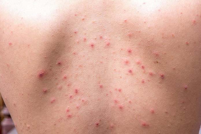 Tratamentos caseiros para manchas de acne nas costas