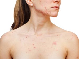 tratamentos caseiros para manchas de acne