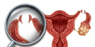 Laqueadura: O que é, como funciona, como é feita, tipos, quem pode fazer laqueadura