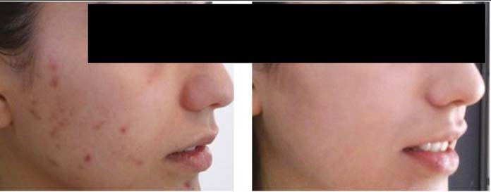 Peeling químico - Benefícios, preço, cuidados, como é feito, antes e depois