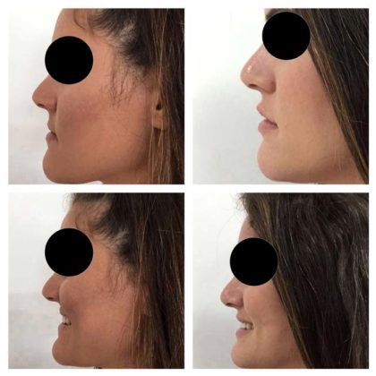 Antes e depois do preenchimento labial