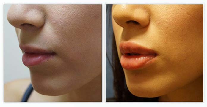 Antes e depois do preenchimento labial