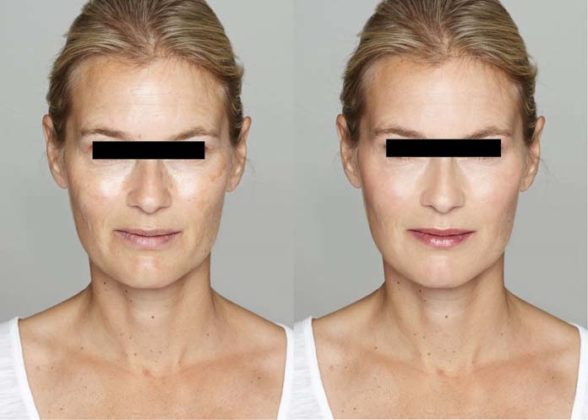 Antes e depois Lifting facial