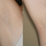 depilação a laser antes e depois