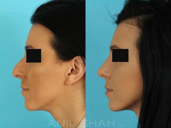 Antes e depois de fazer rinoplastia