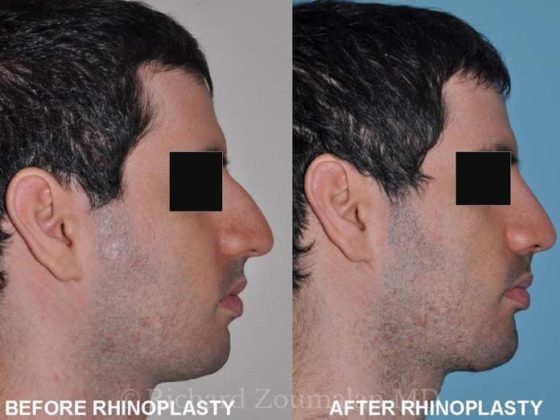 Antes e depois de fazer rinoplastia