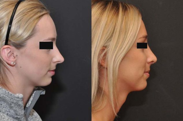 Antes e depois de fazer rinoplastia