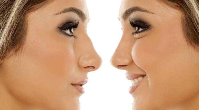 Rinoplastia: O que é? Como é feita? Cuidados, recuperação, antes e depois e mais! Rinoplastia