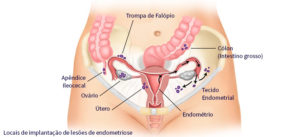 orgaos afetados pela Endometriose