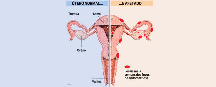 utero com e sem Endometriose