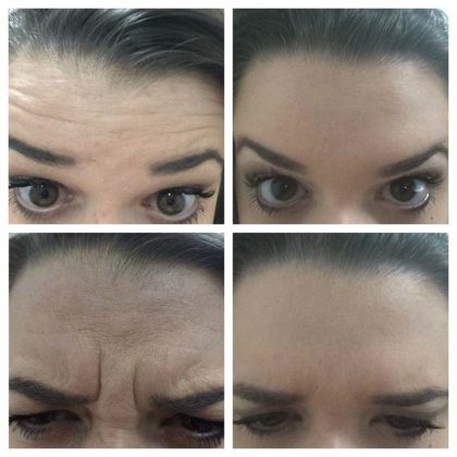 botox antes e depois