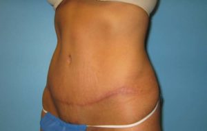 Abdominoplastia cicatrizada