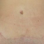 Abdominoplastia-cicatrizada-06