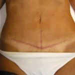 Abdominoplastia-cicatrizada-07