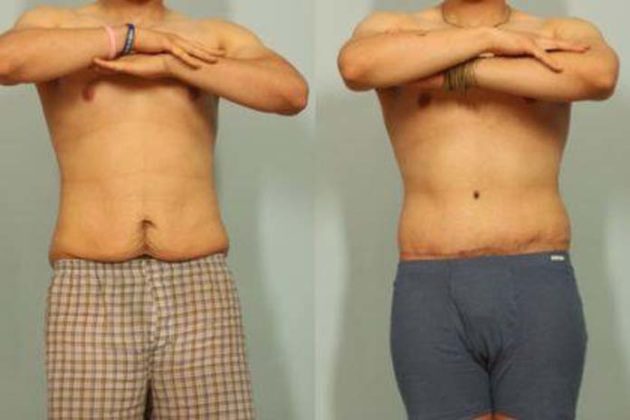 Abdominoplastia masculina