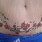 Abdominoplastia-tatuagem-02