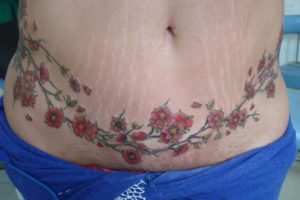 abdominoplastia tatuagem