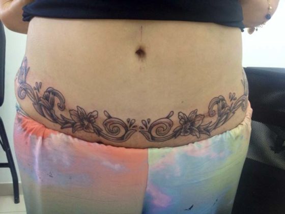 abdominoplastia tatuagem