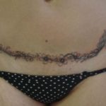 Abdominoplastia-tatuagem-04