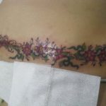 Abdominoplastia-tatuagem-06