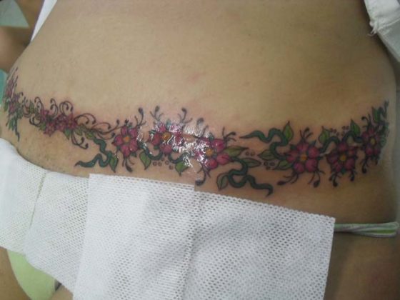 abdominoplastia tatuagem