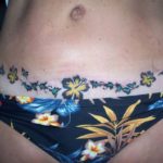 Abdominoplastia-tatuagem-08