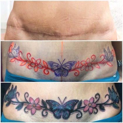 abdominoplastia tatuagem