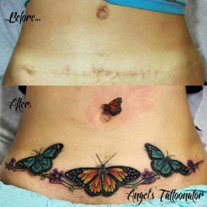 abdominoplastia tatuagem