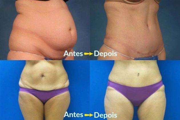 Antes e depois da Abdominoplastia