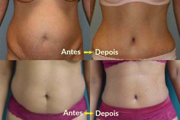 Antes e depois da Abdominoplastia