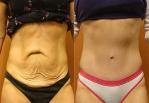 Antes e depois da Abdominoplastia