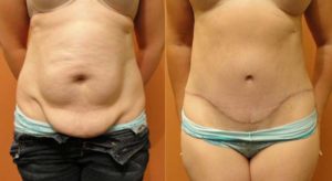 Antes e depois da Abdominoplastia