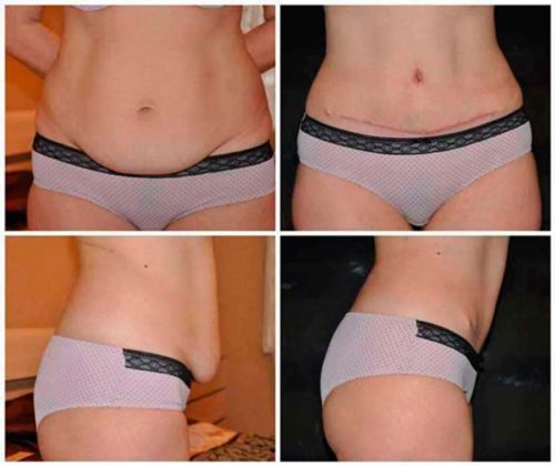 Antes e depois da Abdominoplastia