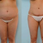 abdominoplastia-antes-e-depois-10