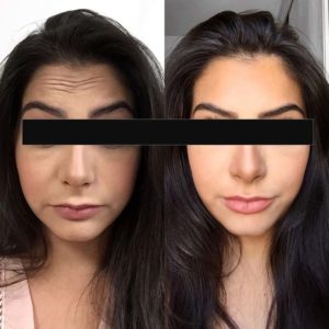 Preenchimento facial antes e depois