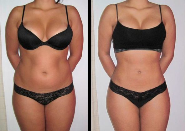 Lipoescultur Qual é o valor como é feita Existem complicações