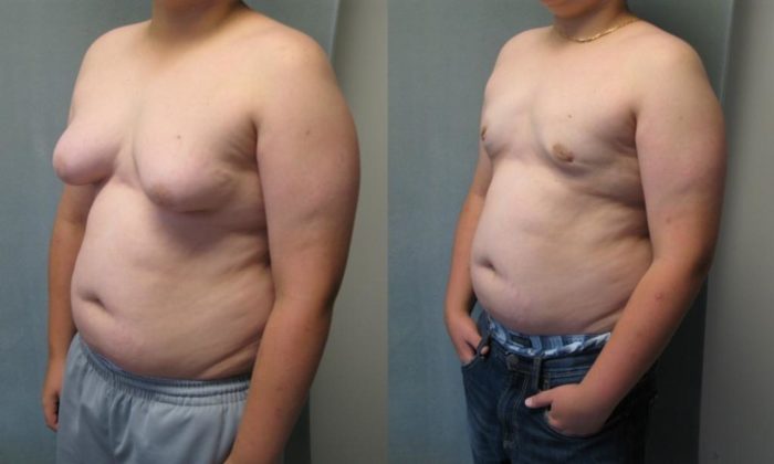 antes e depois da mamoplastia