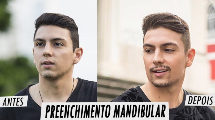 harmonização facial masculina antes e depois
