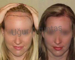 transplante capilar feminino antes e depois