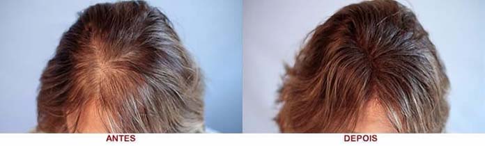 Fototerapia capilar antes e depois